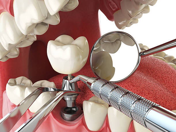 Best Emergency Root Canal Treatment in Avoca, PA
